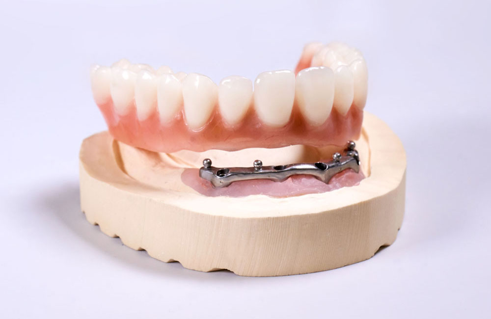 Zęby w jeden dzień Poznań